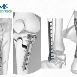 ORTHOPAEDIC IMPLANTS